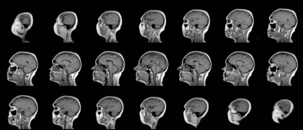 Conjunto de exames de RM seriados de cabeça feminina caucasiana de sessenta anos em plano sagital ou longitudinal — Fotografia de Stock