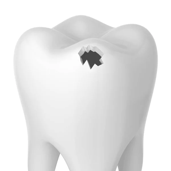 Buraco num dente. ilustração 3d isolado no fundo branco — Fotografia de Stock