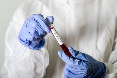 Korumalı giysideki doktor Coronavirus COVID-19 analizi için kanla test tüpü tutuyor. Çin koronavirüsü konsepti. Grip aşısı, koronavirüs, ebola..