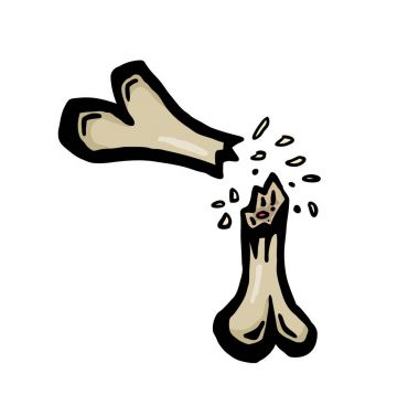 Kırık kemik boyalı