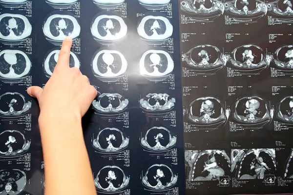 CT (bilgisayarlı tomografi) akciğer, pulmoner emboli (Pe), pneum — Stok fotoğraf