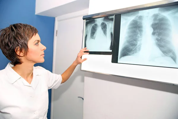 Radiografia de pulmão, embolia pulmonar (EP), hipertensão pulmonar, C — Fotografia de Stock