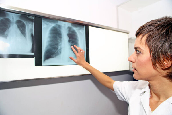 X-ray of lung, pulmonary embolism(PE), pulmonary hypertension, C