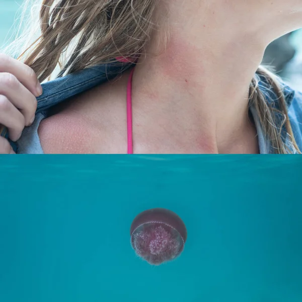 Woman's neck with jelly fish bite and jellyfish in the sea — Stock Photo, Image