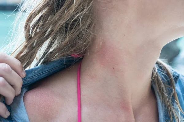 Woman's neck with jelly fish bite — Stock Photo, Image