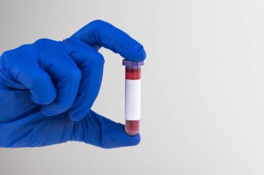 Hemşirenin elinde kan tüpü var, yakın plan. Kan testi kavramı
