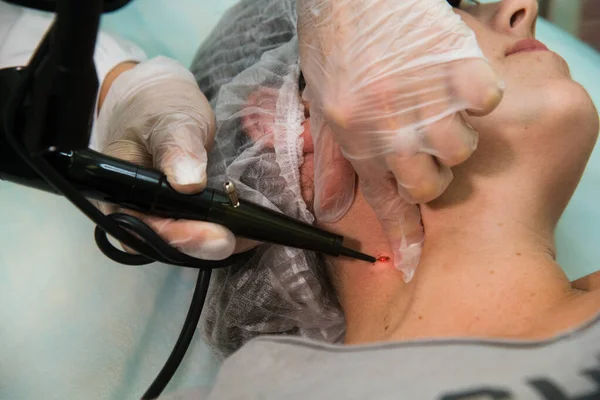 Удаление папилломы, родинки с помощью лазерного прибора в медицине — стоковое фото