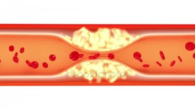 Stent Uygulamaları, şematik 3d animasyon