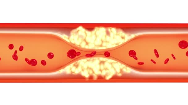 Стентирование, схематическая 3D анимация
