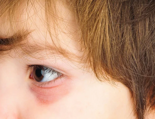 Pink eye on a boy child, at closeup with brown eye and brunette — Stock Photo, Image