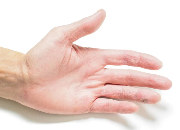 Finger with infected cut, on hand with dry skin, towards white w — Stock Photo, Image