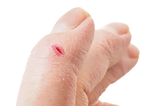 Крупный план пальца с инфицированным порезом, изолированный на белой спине Лицензионные Стоковые Фото