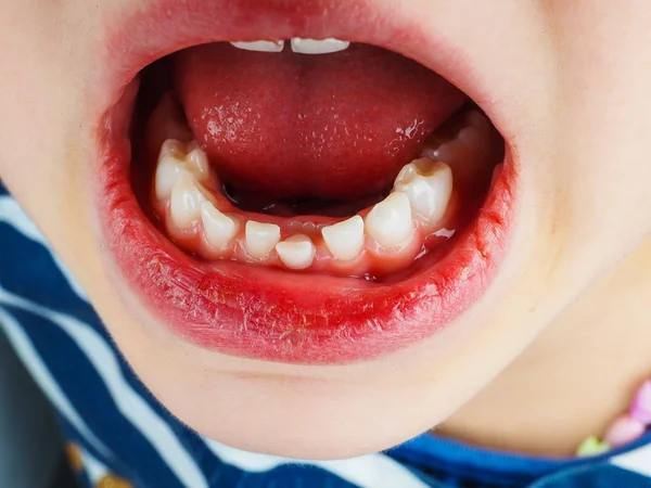 Close-up van verliezen tand in een beetje meisjes mond — Stockfoto