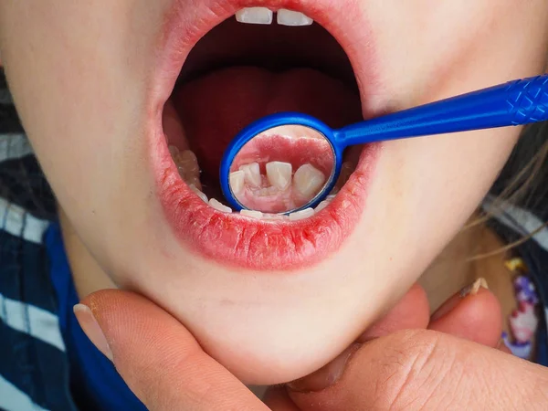 Niña en el dentista examinando un diente perdido con un diente dental Imagen de stock