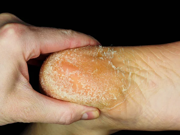 Δέρμα ξεφλούδισμα από τη φτέρνα του ενός ενήλικου προσώπου προς μαύρο — Φωτογραφία Αρχείου