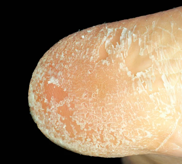 Closeup of skin peeling off from foot towards black Stock Photo