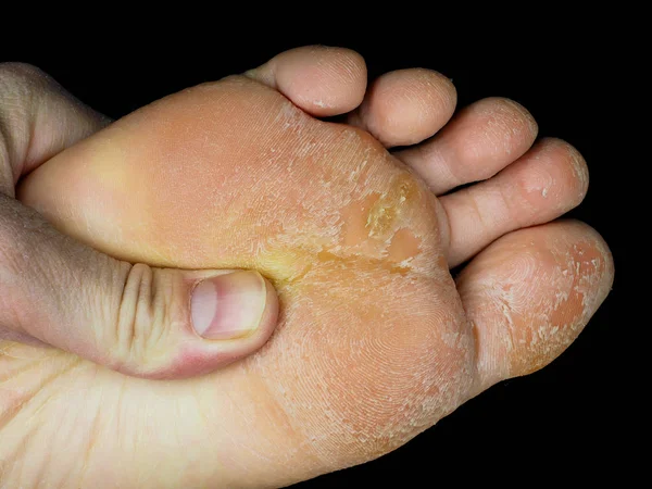Skin peeling off from under foot, at closeup towards black Royalty Free Stock Photos