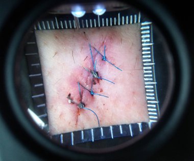 Makrodan dikişli yara