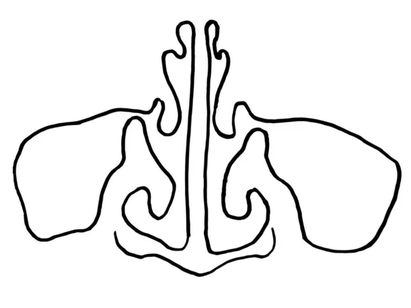 Векторний Контурний Малюнок Верхньощелепного Синуса Ніс Страждає Від Коронавірусу Або — стоковий вектор