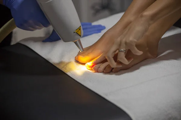 Лазерное лечение грибков ногтей — стоковое фото