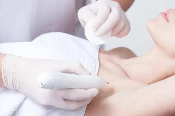 Woman during wart removal on skin — Stock Photo, Image