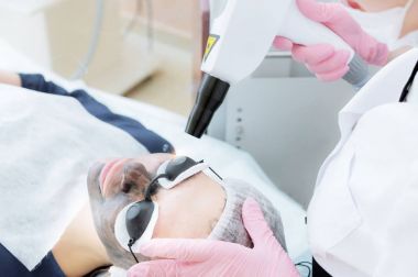 Karbon surat soyma prosedürü. Lazer darbeleri yüz derisini temizler. Donanım kozmetoloji tedavisi. Fototermoliz süreci, deriyi ısıtma, lazer karbon soyma. Yüz derisi