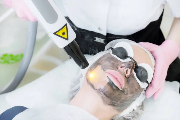 Close-up carbon face peeling procedure. Laser pulses clean skin of the face. Hardware cosmetology treatment. Process of photothermolysis, warming the skin, laser carbon peeling. Facial skin
