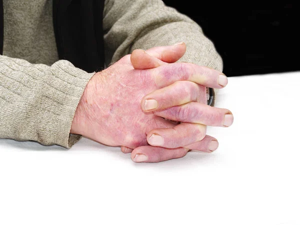 Closeup of the wrinkled hands of an old caucasian man — Stock Photo, Image