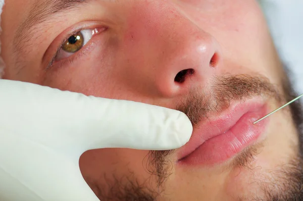 Closeup jovem homem rosto recebendo injeções de tratamento cosmético facial, médicos mão com luva segurando seringa — Fotografia de Stock