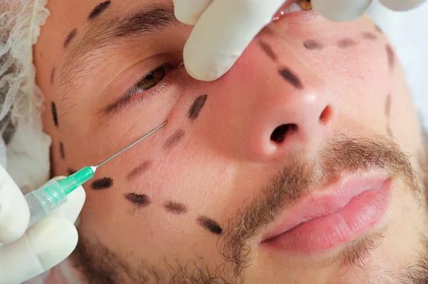 Closeup jonge mans gezicht, zwarte lijnen getekend, ontvangst van cosmetische gezichtsbehandeling injecties, artsen hand met handschoen bedrijf spuit — Stockfoto