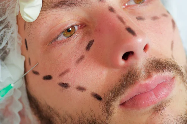 Cara de hombre joven de primer plano, líneas negras dibujadas a su alrededor, recibiendo inyecciones de tratamiento cosmético facial, manos de doctores con jeringa de sujeción de guantes — Foto de Stock