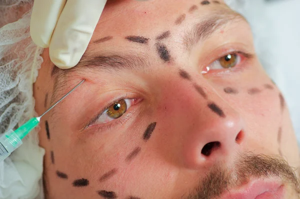 Closeup mladý mans tvář, černé čáry kolem něj, aplikaci injekcí kosmetické ošetření obličeje, ruky lékaři rukavice hospodářství stříkačkou — Stock fotografie