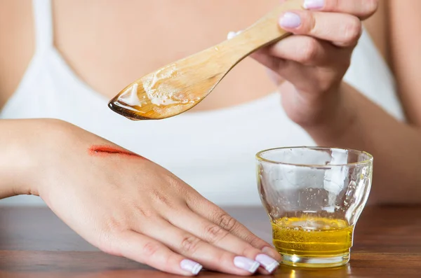 Young model sitting down using wooden knife applying honey to bloody scar on hand — Stock Photo, Image