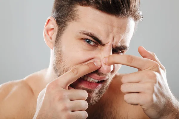 Close up portrait of a man squeezing pimple on his face — Stock Photo, Image