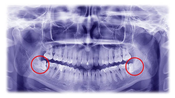 Kadın röntgen, Diş yirmilik dişler yatay pozisyon 