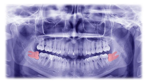 Kadın röntgen, Diş yirmilik dişler yatay pozisyon 