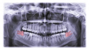 x-ray uygun olmayan şekilde büyüyen molar diş diş