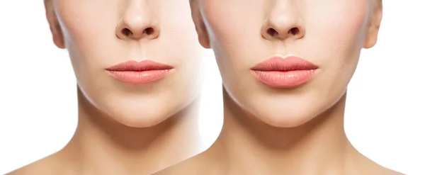 Женщина до и после наполнителей губ — стоковое фото