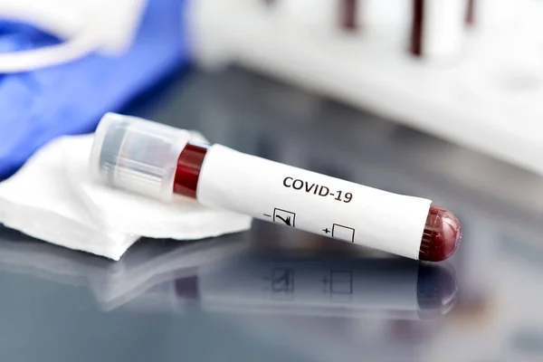 Becher con esame del sangue coronavirus in laboratorio — Foto Stock