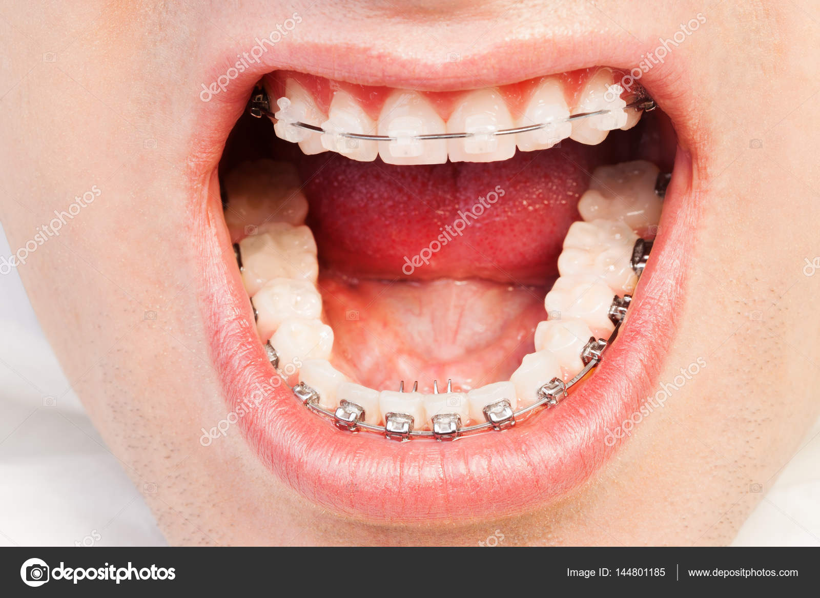 Opened mouth with orthodontic braces — Stock Photo © serrnovik 144801185
