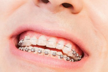 Male mouth with orthodontic braces clipart