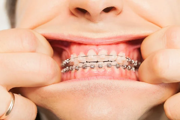 Открытый рот с ортодонтическими брекетами — стоковое фото