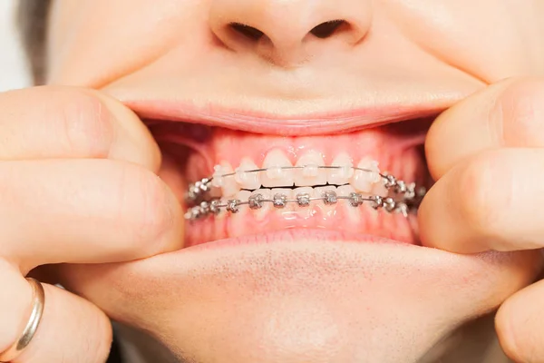 Geopende mond met orthodontische beugel — Stockfoto