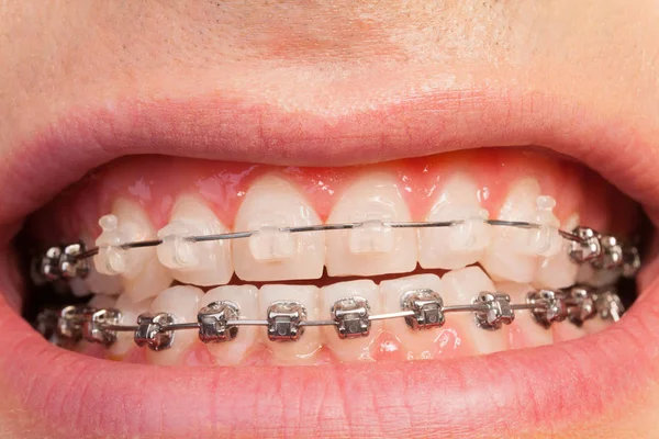 Mannelijke mond met orthodontische beugel — Stockfoto