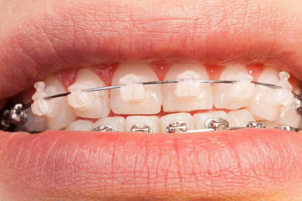 Male mouth with orthodontic braces