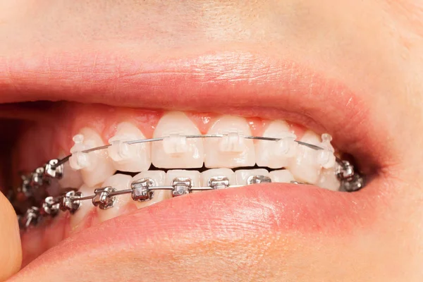 Мужской рот с ортодонтическими брекетами — стоковое фото