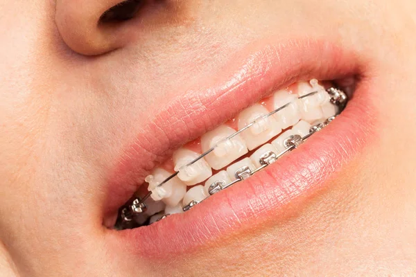 Mannelijke mond met orthodontische beugel — Stockfoto