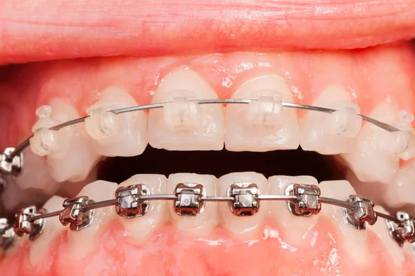 Bouche masculine avec orthèses orthodontiques — Photo