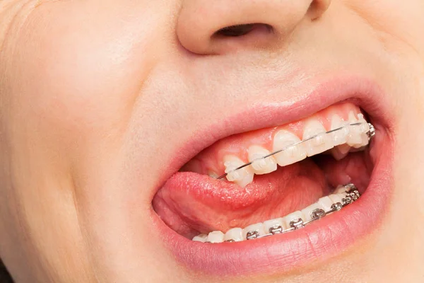 Мужской рот с ортодонтическими брекетами — стоковое фото