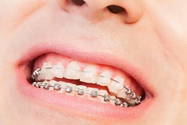 Mannelijke mond met orthodontische beugel — Stockfoto